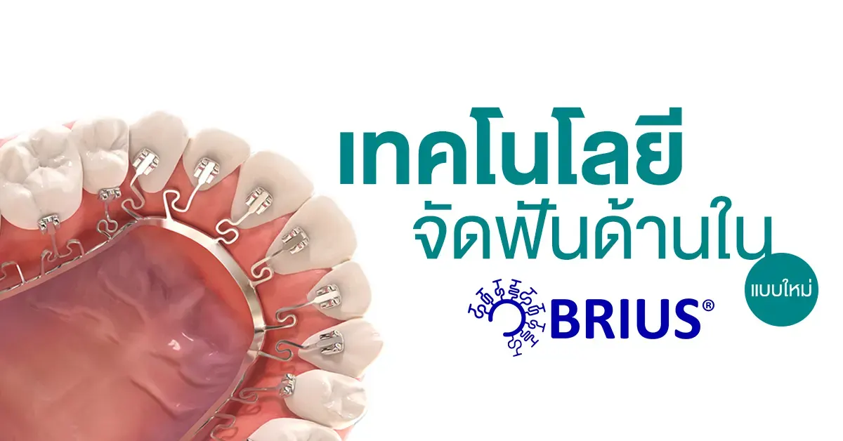 จัดฟันด้านใน-Brius