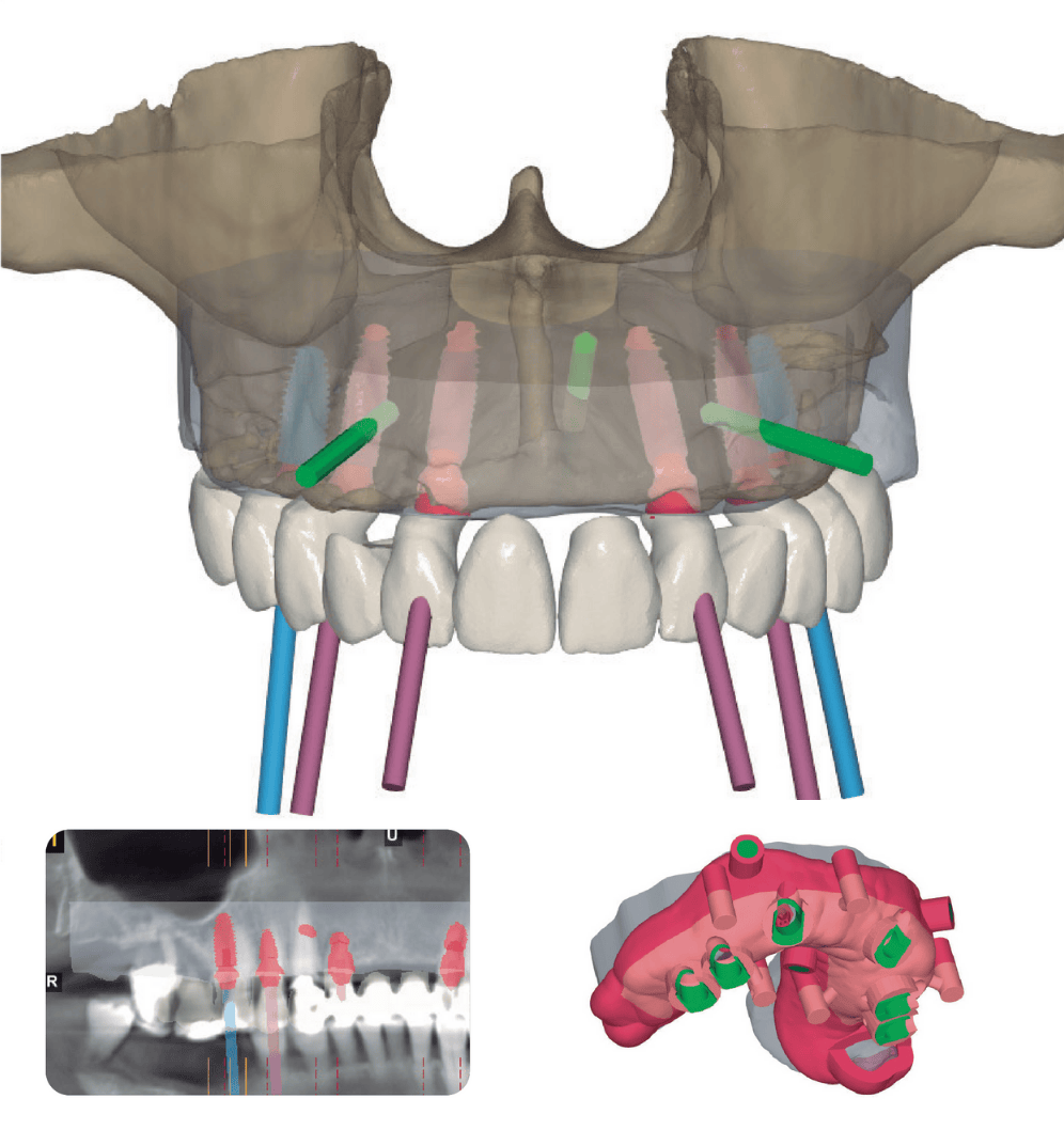 รากฟันเทียมดิจิทัล Vertex Dental