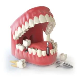 Dental Implant
