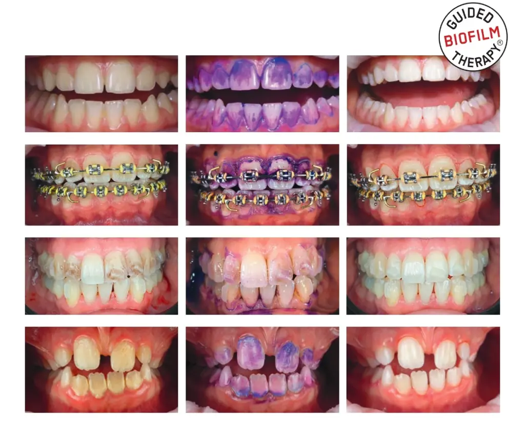 ตัวอย่างเคสที่ใช้บริการ GBT Air Flow Dental Spa