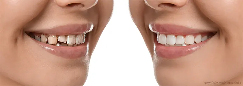 เปรียบเทียบการไม่ทำและทำวีเนียร์