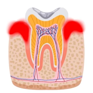 เหงือกอักเสบ
