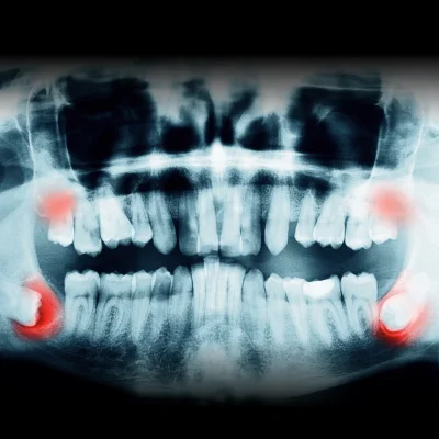 เอ็กซเรย์ฟันคุด