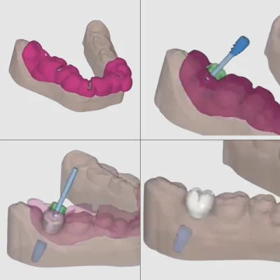 Digital Guided Surgery
