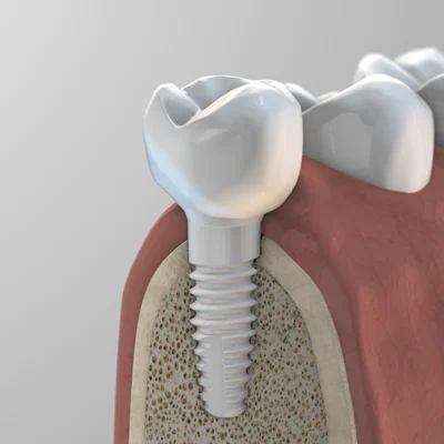 zeramex_xt_monolithic_crown
