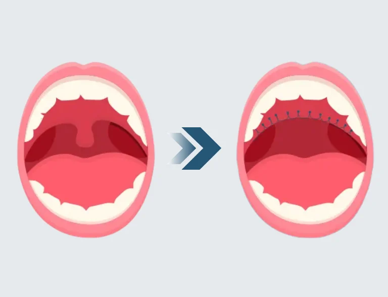 การผ่าตัดเพดานอ่อนและลิ้นไก่