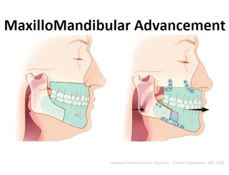 การผ่าตัดเลื่อนขากรรไกร