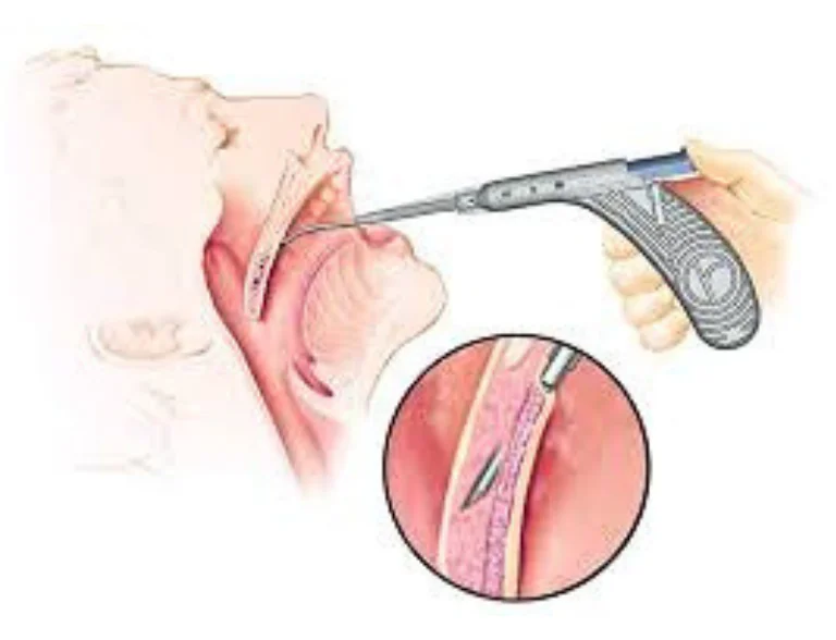 การรักษาด้วยคลื่นความถี่วิทยุ หรือ RF