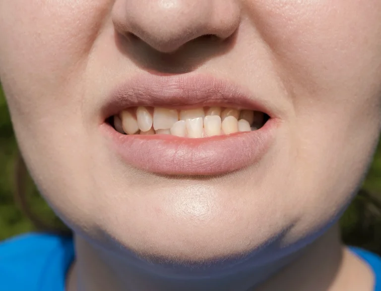 ความผิดปกติของการสบฟัน