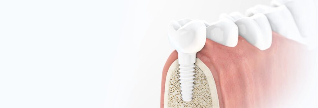 รากฟันเทียม เหมาะกับใคร