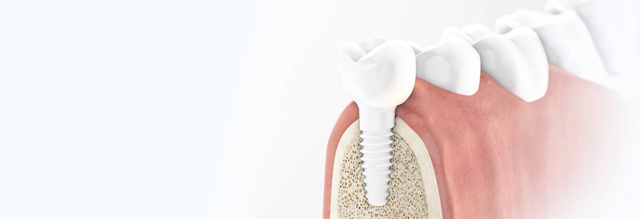 รากฟันเทียม เหมาะกับใคร